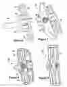 Fig. 05 - SPINOUS PROCESS IMPLANT AND METHOD OF FIXATION