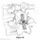 Fig. 06 - SPINOUS PROCESS IMPLANT AND METHOD OF FIXATION