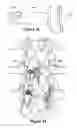 Fig. 11 - SPINOUS PROCESS IMPLANT AND METHOD OF FIXATION