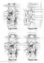 Fig. 16 - SPINOUS PROCESS IMPLANT AND METHOD OF FIXATION