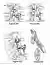 Fig. 18 - SPINOUS PROCESS IMPLANT AND METHOD OF FIXATION