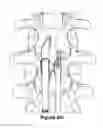 Fig. 22 - SPINOUS PROCESS IMPLANT AND METHOD OF FIXATION