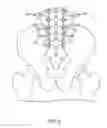 Fig. 09 - Polyaxial bone screw with lateral connector