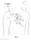 Fig. 02 - Capture threshold measurement for selection of pacing vector