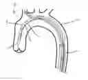 Fig. 01 - DELIVERY SYSTEM FOR BRANCHED STENT GRAFT