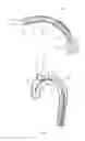 Fig. 03 - DELIVERY SYSTEM FOR BRANCHED STENT GRAFT