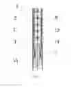 Fig. 05 - DELIVERY SYSTEM FOR BRANCHED STENT GRAFT