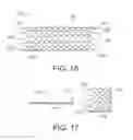 Fig. 06 - STENTS WITH ATTACHED LOOPED ENDS