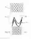 Fig. 12 - Percutaneously implantable flap stent, device for applying the same and method for producing the flap stent