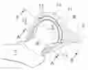 Fig. 01 - Hip joint device and method