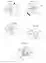 Fig. 12 - Hip joint device and method