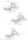 Fig. 13 - Hip joint device and method