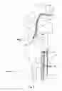 Fig. 02 - ENDOSCOPIC IMPLANTABLE DEVICE AND METHOD FOR THE APPOSITION OF THE STOMACH WALLS FOR REDUCING THE STOMACH INTERNAL VOLUME IN A WEIGHT LOSS SURGERY PROCEDURE