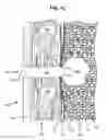 Fig. 03 - PNEUMOSTOMA MANAGEMENT SYSTEM PACKAGING AND KITS