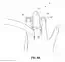 Fig. 08 - URINARY INCONTINENCE DEVICE AND METHOD