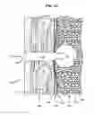 Fig. 03 - PNEUMOSTOMA MANAGEMENT SYSTEM PACKAGING AND KITS