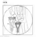 Fig. 06 - Method and a system for assessing the relative pose of an implant and a bone of a creature