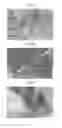 Fig. 03 - Bone graft and biocomposite for prosthetic dentistry