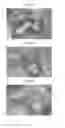 Fig. 04 - Bone graft and biocomposite for prosthetic dentistry
