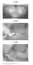 Fig. 05 - Bone graft and biocomposite for prosthetic dentistry