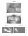 Fig. 06 - Bone graft and biocomposite for prosthetic dentistry
