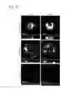 Fig. 04 - METHOD FOR INDUCING DIFFERENTIATION OF EMBRYONIC STEM CELLS OR ARTIFICIAL PLURIPOTENT STEM CELLS