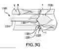 Fig. 07 - Methods for renal denervation