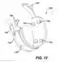 Fig. 09 - Gastric band device and method