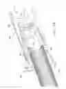 Fig. 20 - Rotate-to-advance catheterization system