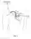 Fig. 02 - Implantable medical sensor and fixation system