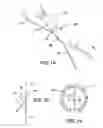 Fig. 13 - Implantable medical sensor and fixation system