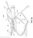 Fig. 17 - Implantable medical sensor and fixation system