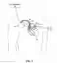 Fig. 02 - Implantable medical sensor and fixation system