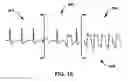 Fig. 17 - MORPHOLOGY CHANGE DETECTION FOR CARDIAC SIGNAL ANALYSIS