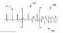 Fig. 01 - MORPHOLOGY CHANGE DETECTION FOR CARDIAC SIGNAL ANALYSIS