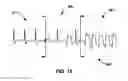 Fig. 17 - MORPHOLOGY CHANGE DETECTION FOR CARDIAC SIGNAL ANALYSIS