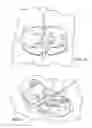 Fig. 04 - Catheter securement device with slit between first and second pull tabs