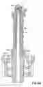 Fig. 19 - Swabbable Needle-Free Injection Port Valve System With Zero Fluid Displacement