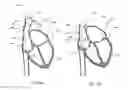 Fig. 06 - Telescoping catheter delivery system for left heart endocardial device placement