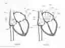 Fig. 07 - Telescoping catheter delivery system for left heart endocardial device placement