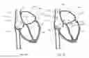 Fig. 08 - Telescoping catheter delivery system for left heart endocardial device placement