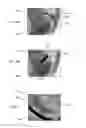 Fig. 09 - Telescoping catheter delivery system for left heart endocardial device placement