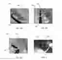 Fig. 10 - Telescoping catheter delivery system for left heart endocardial device placement