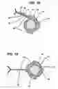 Fig. 14 - INTRAVAGINAL DEVICE WITH FLUID TRANSPORT PLATES AND METHODS OF MAKING