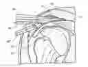 Fig. 01 - Hard tissue ablation system