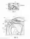 Fig. 06 - Hard tissue ablation system