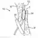 Fig. 01 - METHODS AND ELECTRODE APPARATUS TO ACHIEVE A CLOSURE OF A LAYERED TISSUE DEFECT