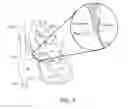 Fig. 02 - METHODS AND ELECTRODE APPARATUS TO ACHIEVE A CLOSURE OF A LAYERED TISSUE DEFECT