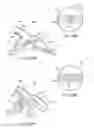 Fig. 28 - METHODS AND ELECTRODE APPARATUS TO ACHIEVE A CLOSURE OF A LAYERED TISSUE DEFECT