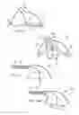 Fig. 32 - METHODS AND ELECTRODE APPARATUS TO ACHIEVE A CLOSURE OF A LAYERED TISSUE DEFECT